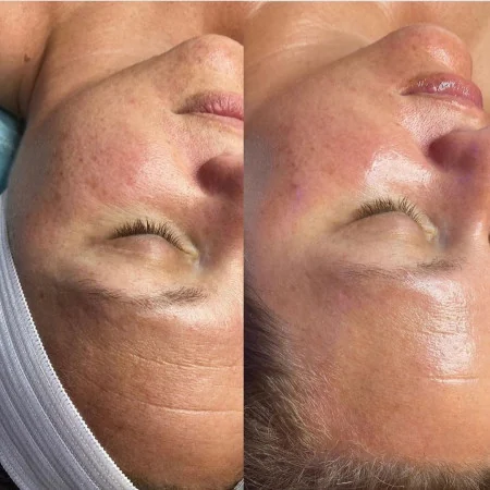 Voor en na een HydraFacial-behandeling: fijne lijntjes rond het oog